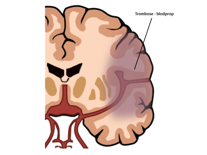 Illustration af en trombose (blodprop) i højre side af hjernen. 