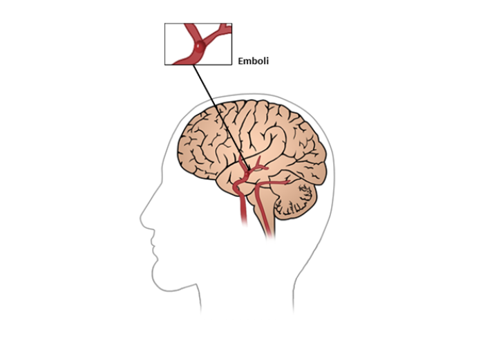 En illustration af en hjerne set fra siden, hvor et udsnit midt i hjernen viser en emboli