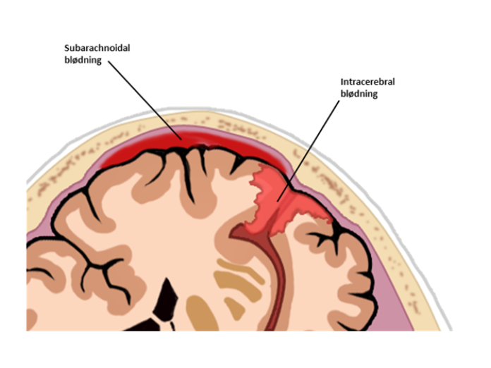 En illustration af en intracerebral blødning og en subarachnoidal blødning i en hjerne. 