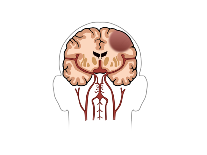 Illustration af en hjerne set bagfra, hvor en tumor er synlig i højre side af hjernen. 